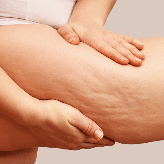 Cellulite