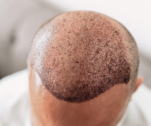 Haartransplantation