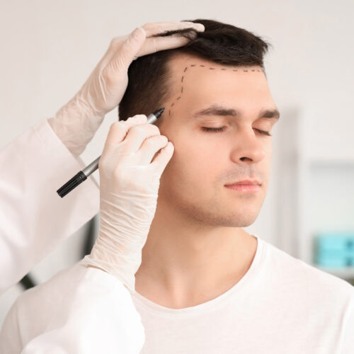 Ein Arzt plant die Durchführung einer Haartransplantation, die mit der Finanzierung von 4beauty ermöglicht wurde